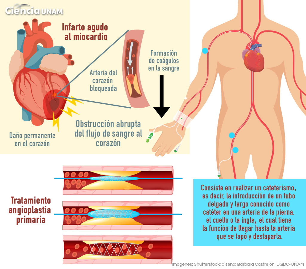 infarto agudo de miocardio.jpeg