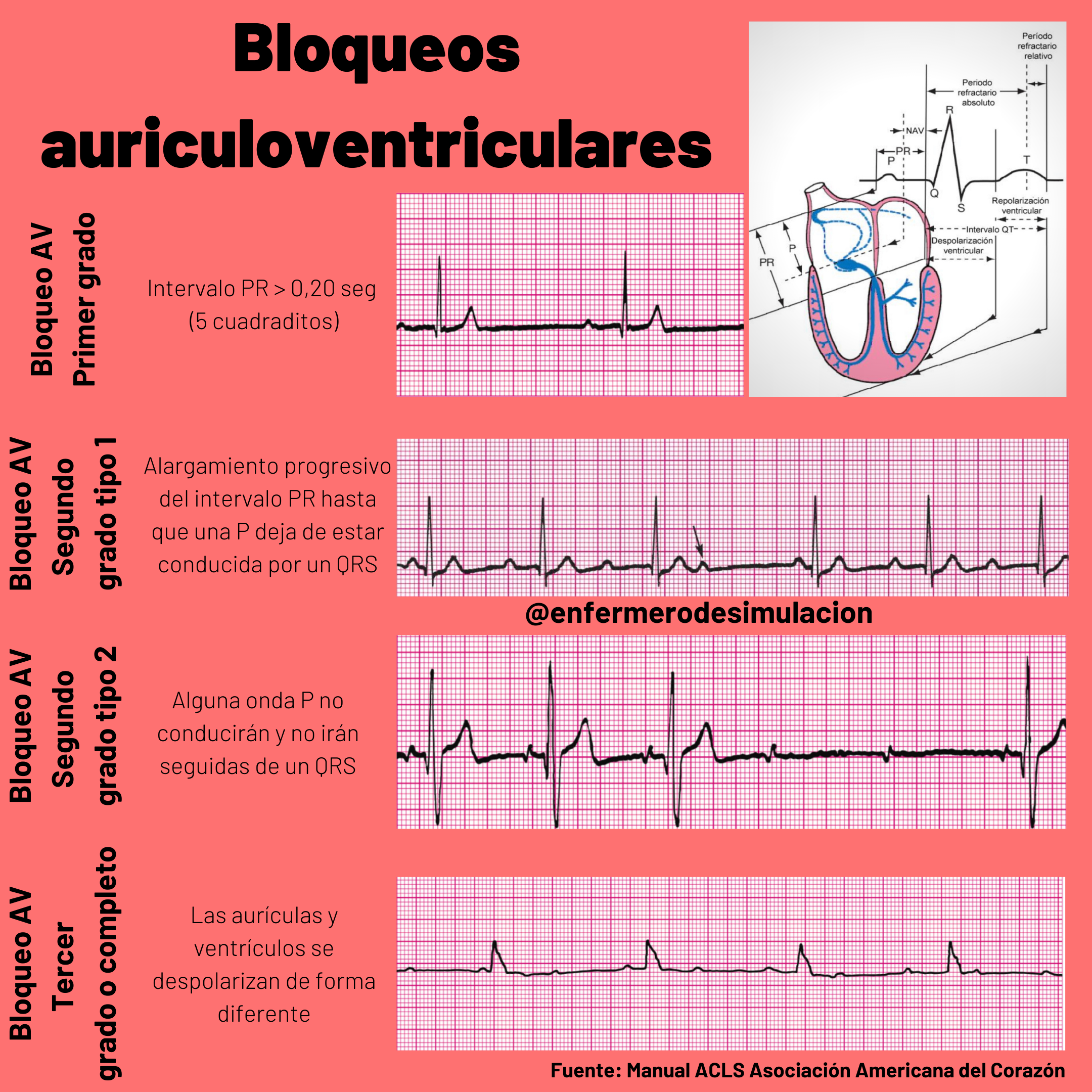 https://enallterm.unam.mx/sites/default/files/webform/wizard_fichatraductologica/1270/bloqueos-auriculoventriculares.png