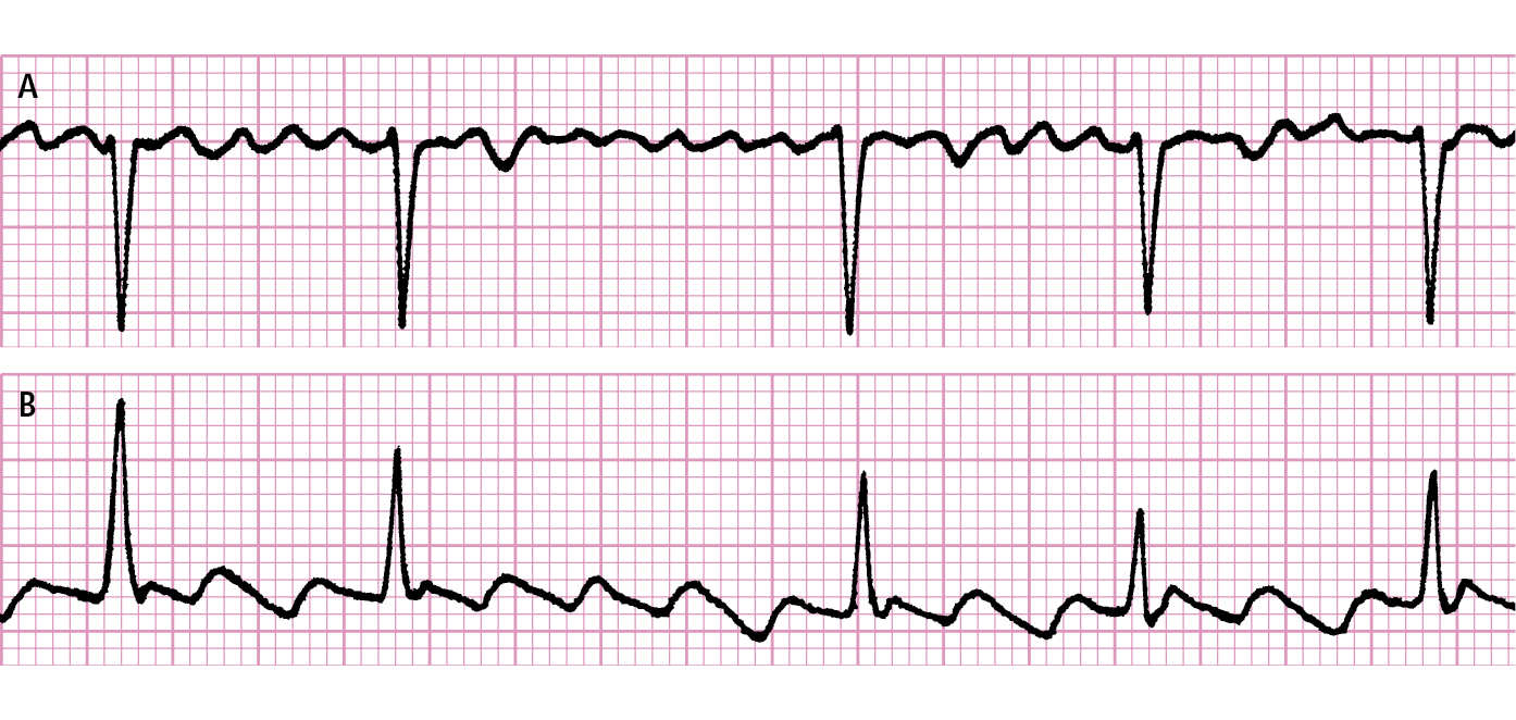 fibrilacion auricular.jpg