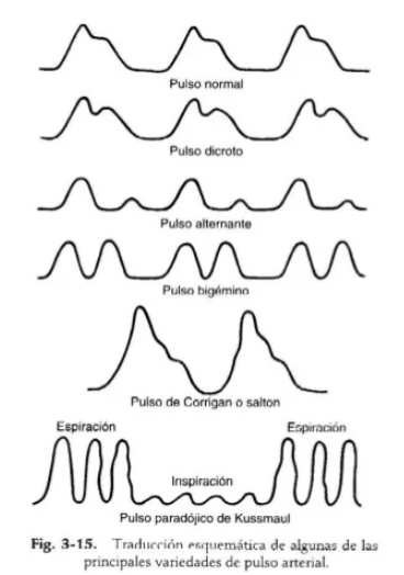 Corrigan pulse (pulso de Corrigan) | ENALLTerm