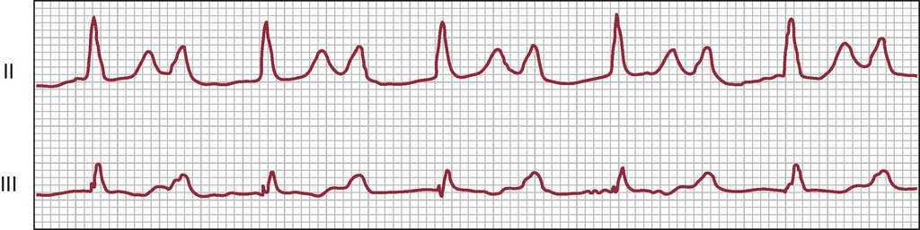 bradyarrhythmias.jpg