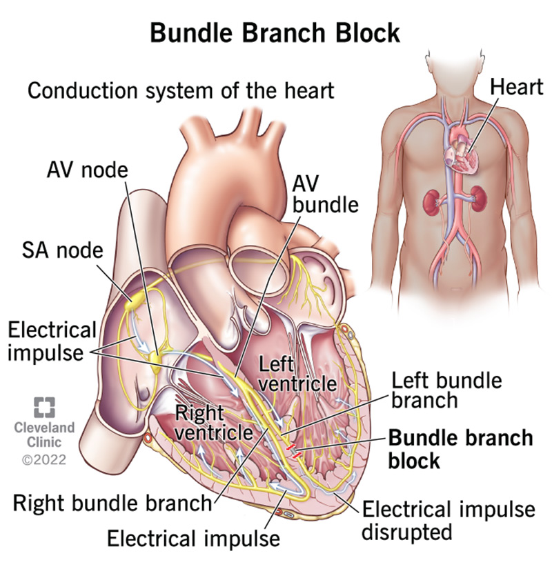 bundle branch block.jpg