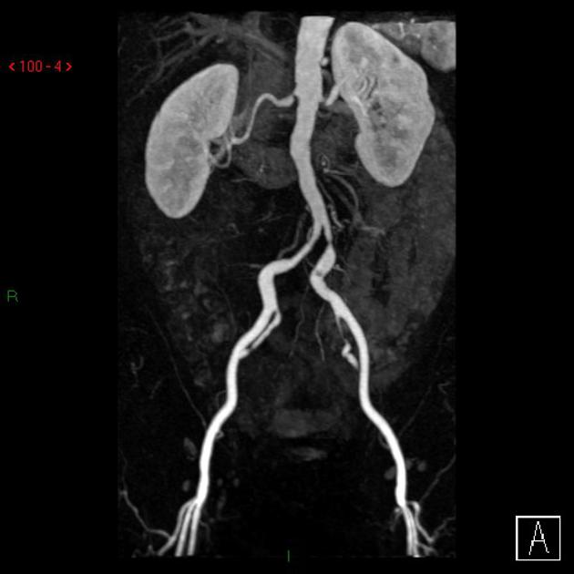 bilateral renal artery stenosis.jpg