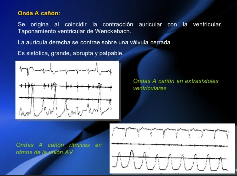 ondas A cañon.png