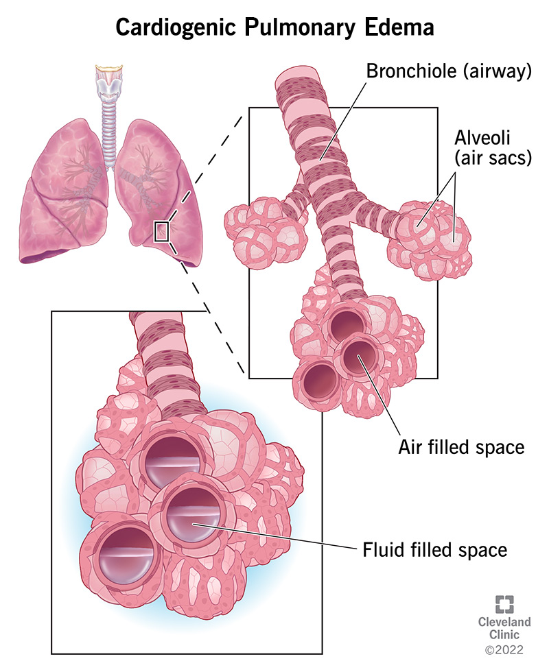 cardiogenic-pulmonary-edema.jpg