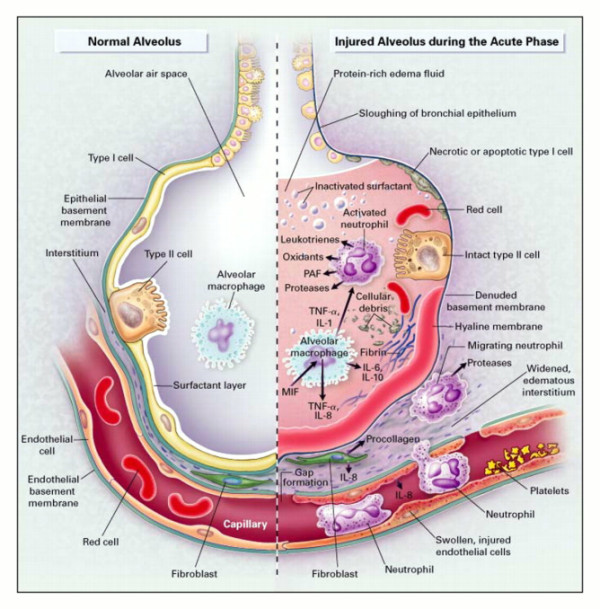 insuficiencia respiratoria aguda.png