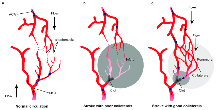 Impact-of-collateral-flow-on-clot-lysis-and-reperfusion-a-Schematic-drawing-of-the.png