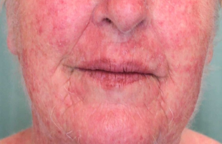 allergic contact dermatitis.jpg allergic contact dermatitis.jpg