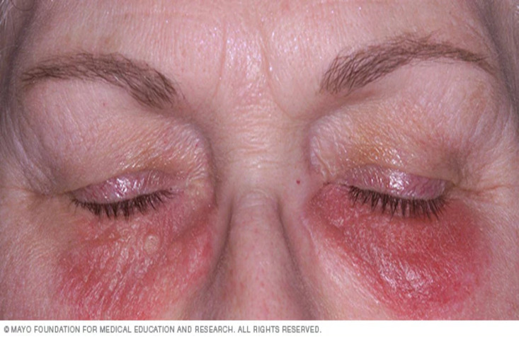 atopic dermatitis.jpg atopic dermatitis.jpg