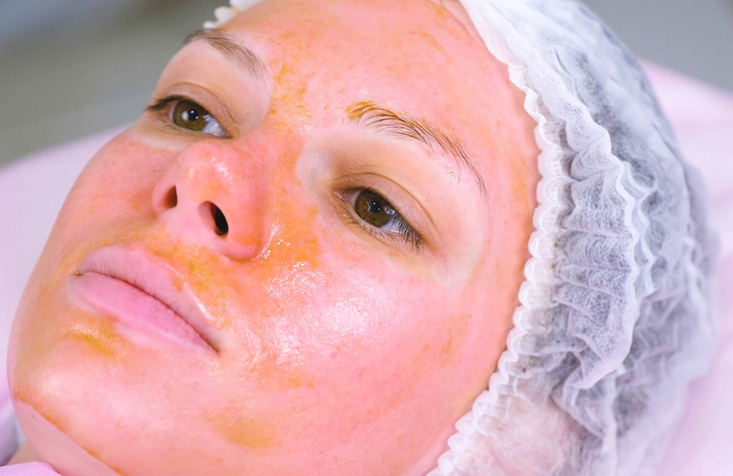 chemical peel.jpg chemical peel.jpg