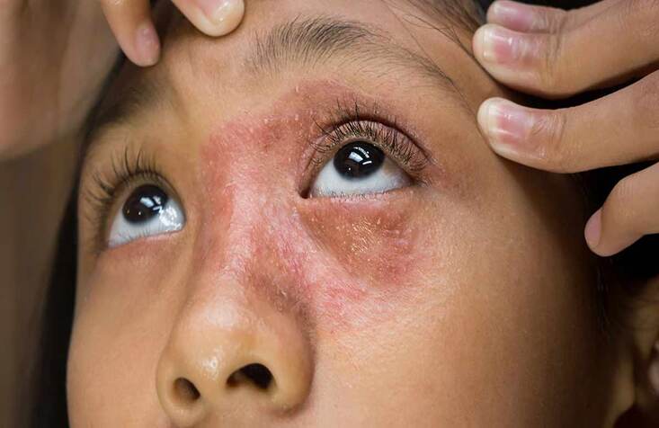 contact dermatitis.jpg