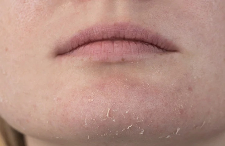 dry skin.jpg dry skin.jpg