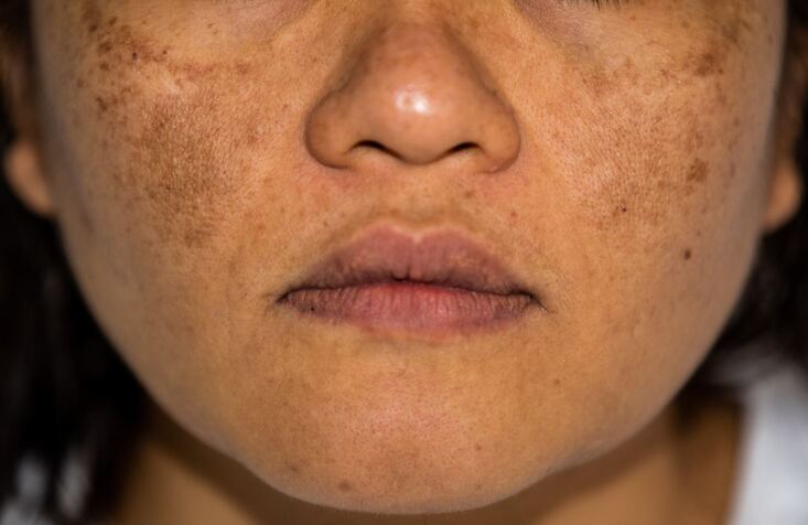 facial hyperpigmentation.jpg facial hyperpigmentation.jpg
