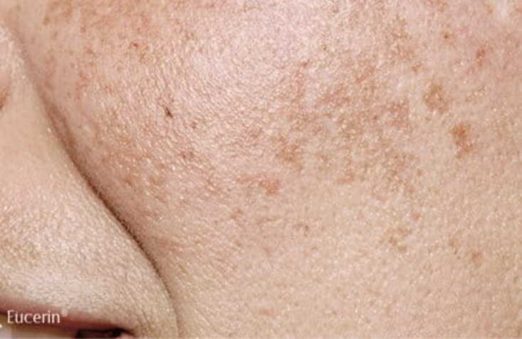 facial melasma.jpg facial melasma.jpg