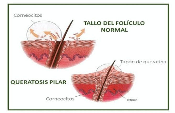 follicular keratinization.jpg follicular keratinization.jpg