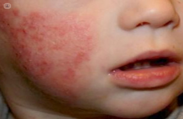 inflammatory dermatitis.jpg