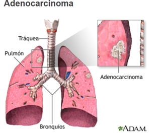 adenocarcinoma.png