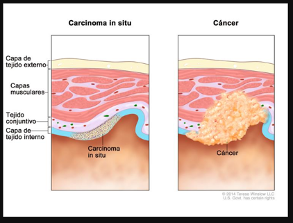 carcinoma .png