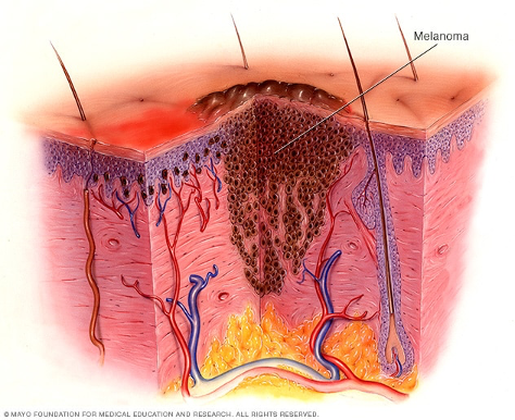 melanoma.png