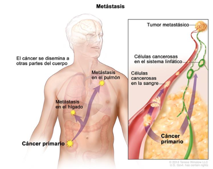 metastasis.png