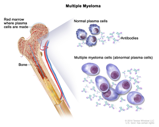 multiple myeloma.png